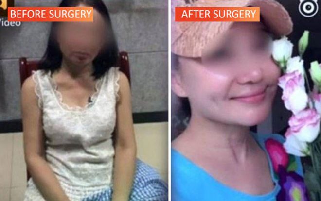 Trốn nợ, người phữ 60 tuổi phẫu thuật thẩm mỹ hàng loạt để thành gái 20