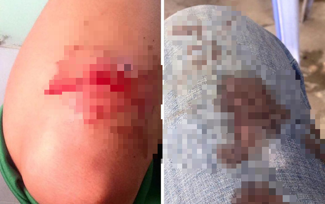 Tài xế GrabBike kể chuyện giúp đỡ người gặp tai nạn để rồi vừa mất tiền lại bị hành hung