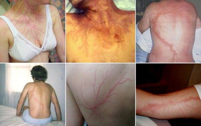 Kinh ngạc dấu vết hằn trên da những nạn nhân sống sót khi bị sét đánh