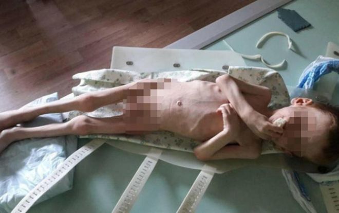 Cậu bé 4 tuổi chỉ còn da bọc xương vì bị bố mẹ bỏ đói gần chết