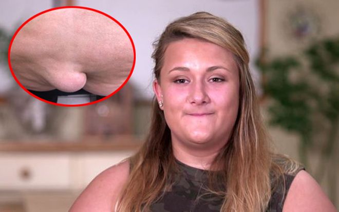 Người phụ nữ mọc 'đuôi' ở mông