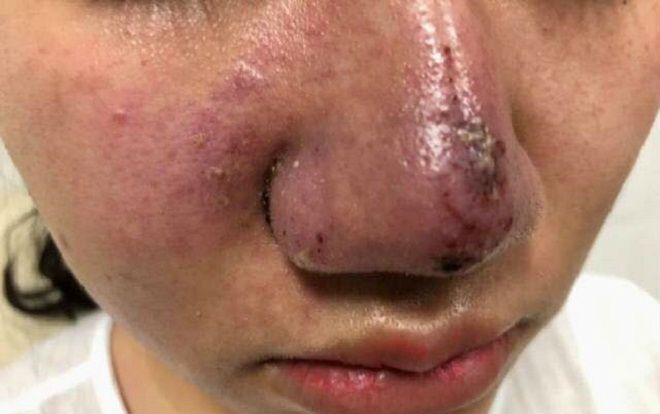 Tiêm filler làm đẹp, cô gái trẻ ở Hà Nội bị méo cằm, lệch má