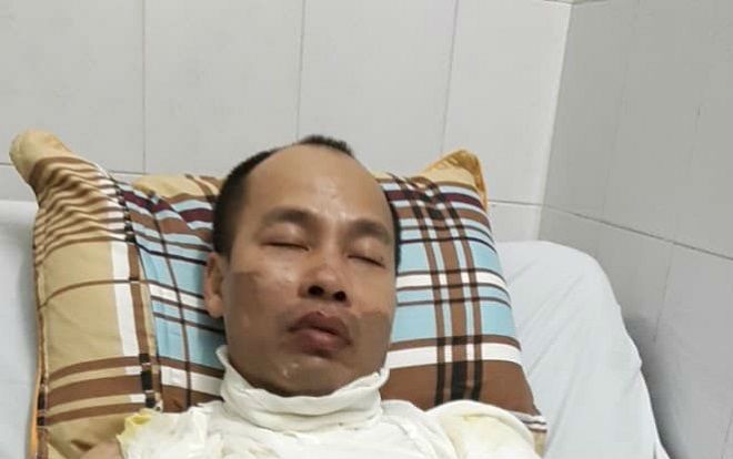 Con gái hoảng loạn chứng kiến cảnh bố bị kẻ lạ mặt tạt axit gây bỏng nặng