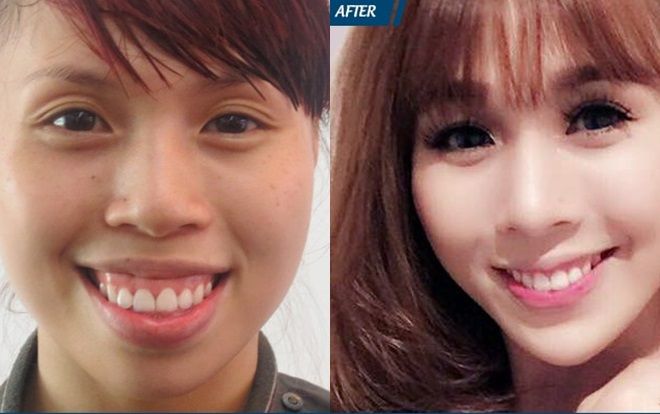 Niềng răng hay phẫu thuật là giải pháp tốt nhất 'xóa bỏ' hô móm