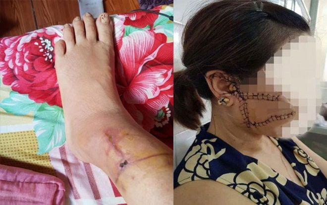 Người phụ nữ tố bị chồng cắt đứt 3 gân chân, rạch mặt do ghen tuông