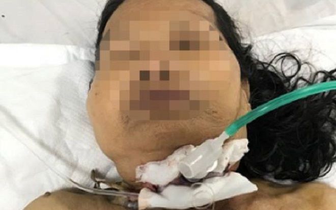 Ngã trúng nơi cháu nội đang mổ gà ăn lễ 2/9, cụ bà 73 tuổi bị dao đâm xuyên cổ