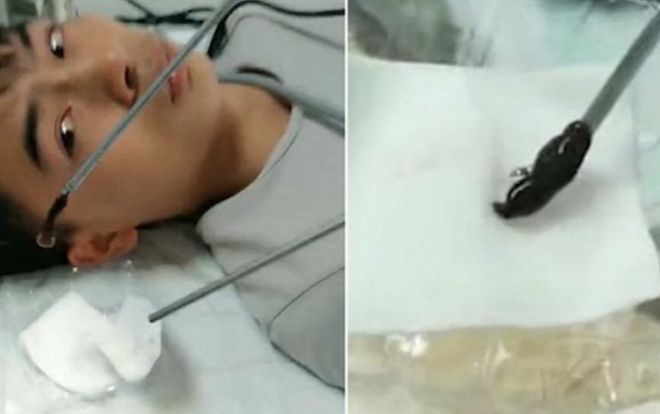 Kinh dị đỉa làm tổ trong lỗ mũi người đàn ông suốt 3 tháng