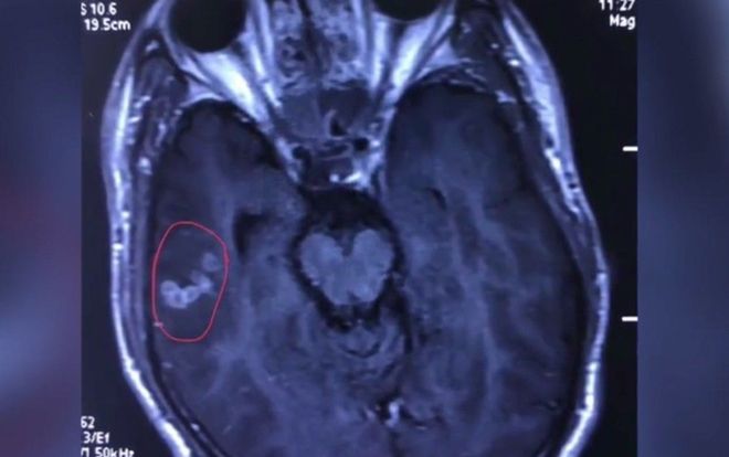 Sán dây dài 10 cm ký sinh trong não thanh niên 'nghiện' đồ nướng