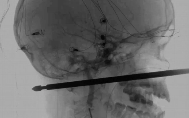 Bị cây xiên thịt dài 30 cm đâm xuyên đầu, cậu bé 10 tuổi vẫn sống sót thần kỳ