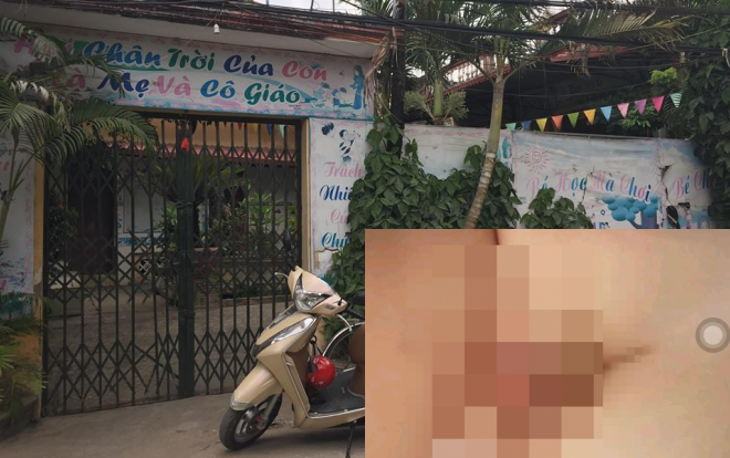 Vụ bé trai 2 tuổi bị đứt vùng kín: Nhà trường giải thích do bị…ngã