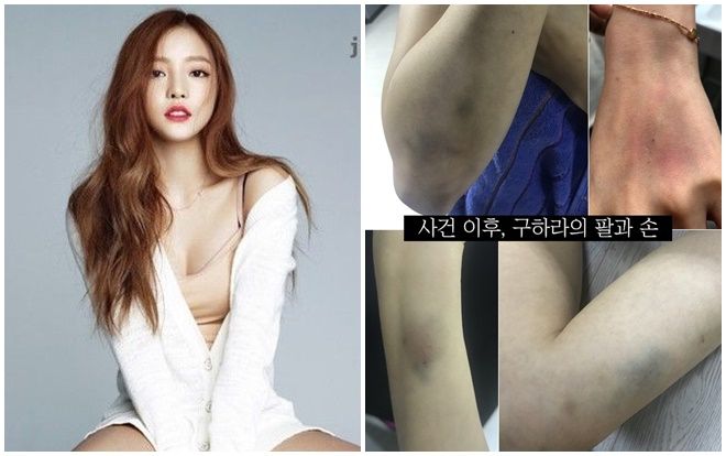 Sự thật thông tin Goo Hara hành hung bạn trai: Bị chảy máu tử cung, âm đạo