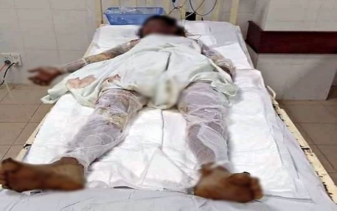 Chồng can ngăn vợ đổ xăng lên người tự tử, 3 người trong gia đình bị bỏng nặng