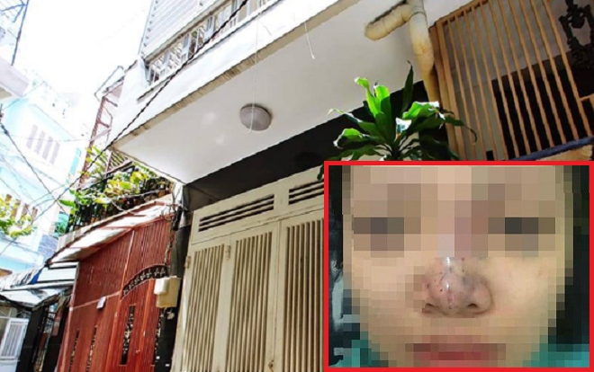 Chủ cơ sở Spa 'chui' ôm 'đồ nghề' bỏ trốn sau khi tiêm filler khiến nữ sinh viên 20 tuổi có nguy có mù vĩnh viễn