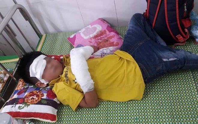 Bé trai dập nát 2 bàn tay vì điện thoại phát nổ
