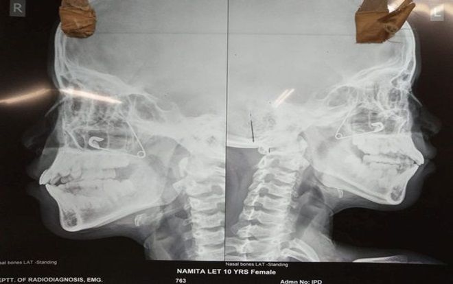 Trót dại dùng kim băng lấy gỉ mũi, bé 10 tuổi khiến bố mẹ phát hoảng