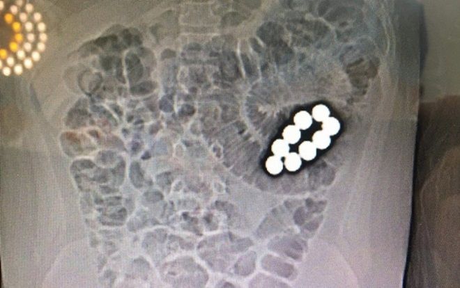 Nghi vấn nam sinh 10 tuổi bị bạn học ép nuốt 9 viên bi vào bụng gây tắc ruột