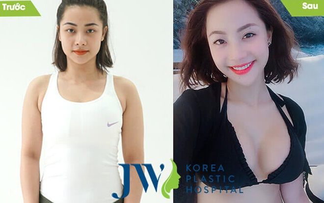 200 suất khuyến mãi dành cho khách hàng đăng ký nâng ngực Nano Chip giọt nước 4.0