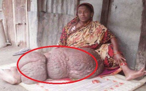 Chân biến dạng nặng gần 60 kg khiến người phụ nữ không thể cử động suốt 18 năm