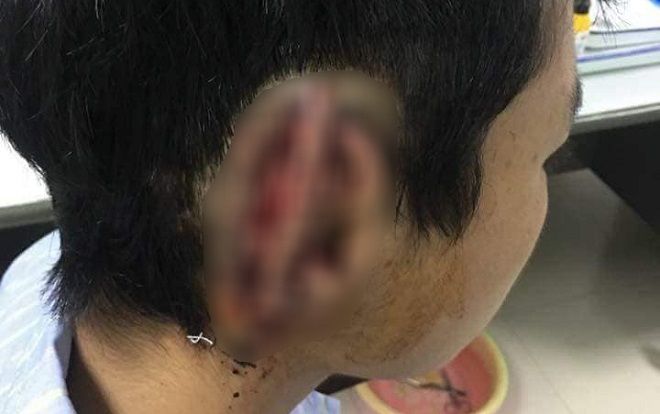Phẫu thuật lấy tai trong bụng của nam sinh lớp 10