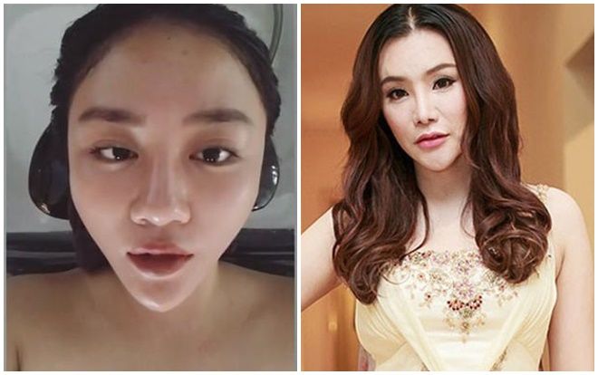 Sao Việt phẫu thuật cằm V-line, người đổi đời, kẻ mang khuôn mặt biến dạng