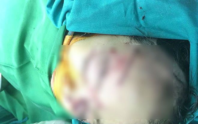 Bé gái 31 tháng tuổi bị chó nhà tấn công vào vùng mặt