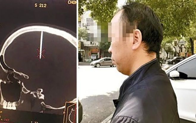 Bác sĩ tá hỏa khi phát hiện đinh dài 48 mm trong hộp sọ bệnh nhân