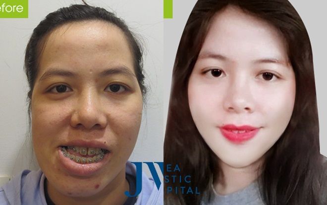 Phép màu giúp cô giáo Bình Định có gương mặt méo lột xác ngoạn mục sau phẫu thuật