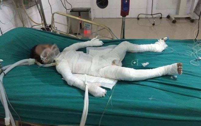 Hà Nội: Bé trai 6 tuổi bị bố dượng tẩm xăng đốt bỏng 98% đã qua đời