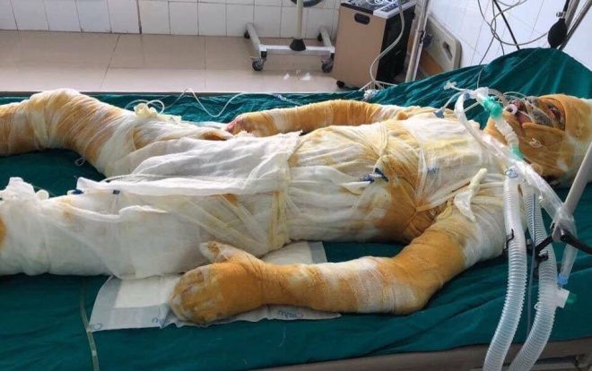 Giúp xưởng mộc chữa cháy, nam thanh niên 25 tuổi bị bỏng lột da toàn thân, tính mạng nguy kịch