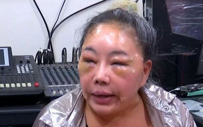 Thực hư vụ nữ đại gia Thái Lan kén chồng 'yêu' 28 lần/ngày bị đánh với gương mặt sưng vù