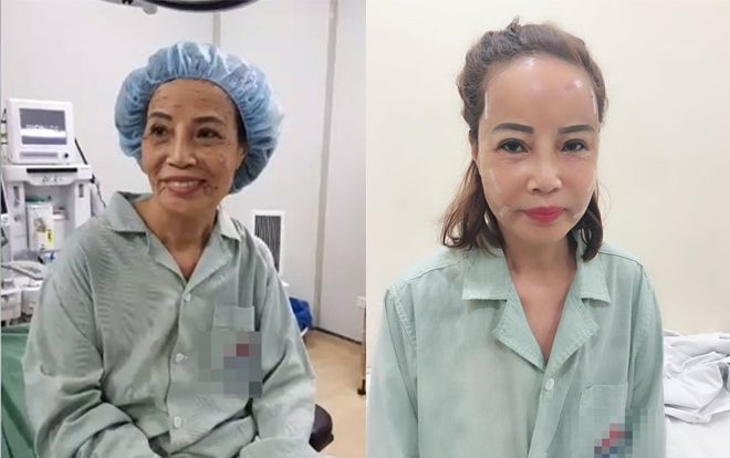 Diện mạo mới gây bất ngờ của cô dâu 61 sau phẫu thuật thẩm mỹ: Dân mạng khen trẻ như mới 40