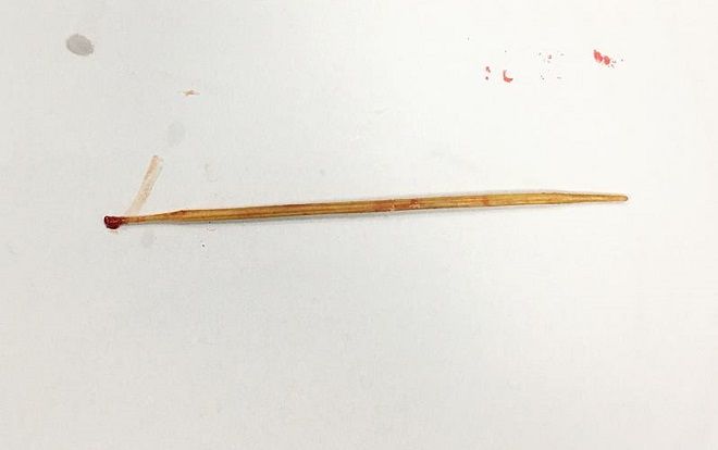 Phẫu thuật lấy que tăm dài 8cm ở vùng mông của bé trai 9 tuổi