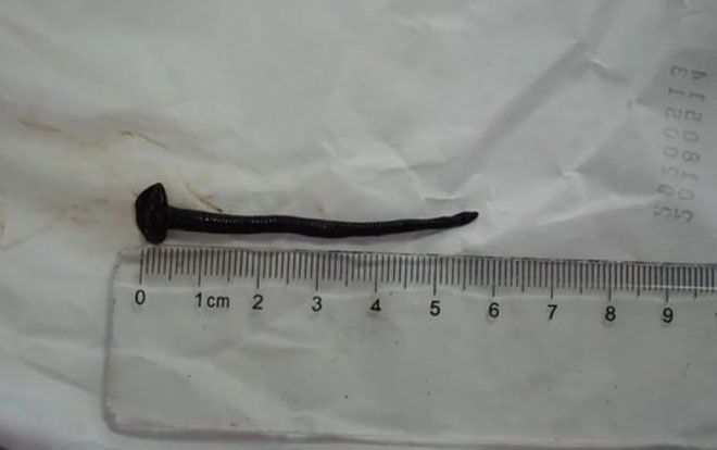 Ho ra máu 10 ngày liên tiếp, bác sĩ tá hỏa khi lôi ra thứ này trong cổ họng cô gái