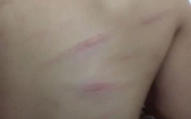 Gia đình phát hiện con học lớp 1 bị đánh bầm lưng, cô giáo giải thích do lười học