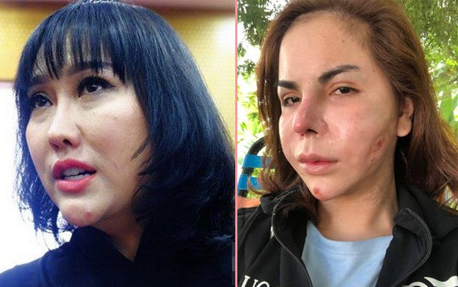 Ham phẫu thuật thẩm mỹ, nhìn Phi Thanh Vân đã thảm, quay sang Hồ Quỳnh Hương, Linda chỉ biết xót xa