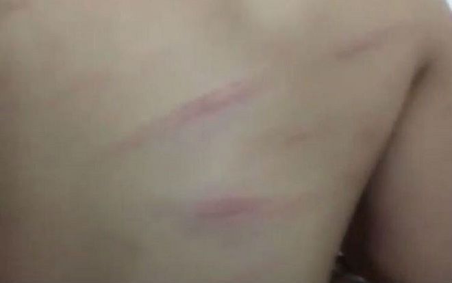 Vụ bé gái lớp 1 bị cô giáo đánh bầm lưng do lười học: Cô giáo bị sốc tâm lý nặng sau sự việc