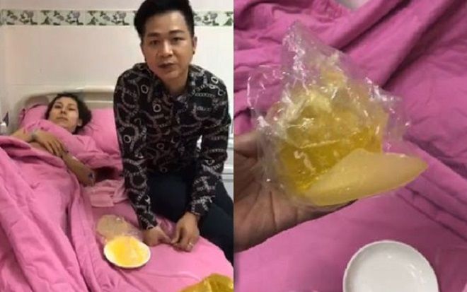 Sốc với cảnh em kết nghĩa của ca sĩ Quách Tuấn Du bất ngờ bị nổ túi ngực 2.000 USD ngay trên máy bay