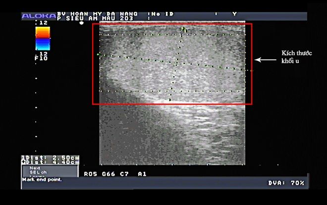 Hi hữu người đàn ông có 3 tinh hoàn ở Đà Nẵng