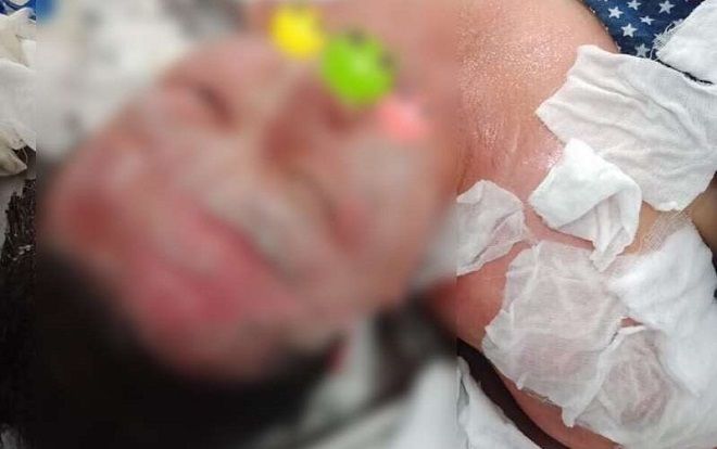 Liều mình thử phương pháp làm đẹp 'đốt cồn lên mặt', người phụ nữ bị bỏng nặng cháy hết tóc