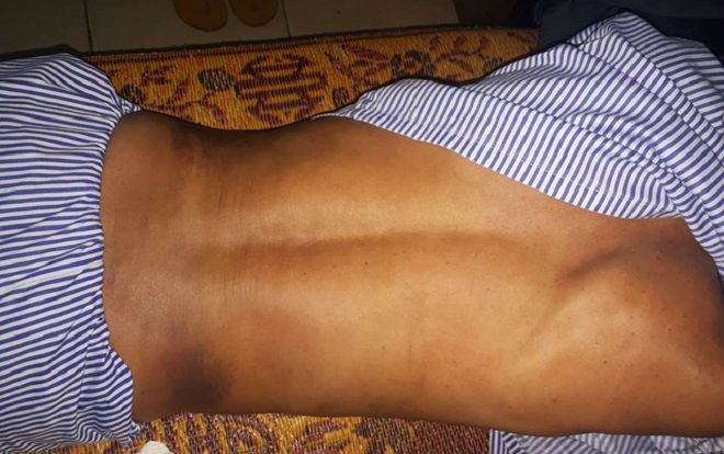 Hà Tĩnh: Ngăn trâu bò thả rông, trưởng thôn bị đánh biến dạng xương sườn