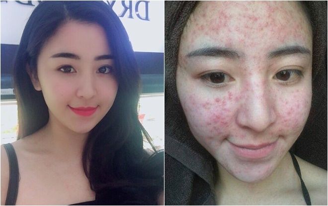 Xuất hiện ảnh 'hot girl bánh tráng trộn' đình đám một thời nổi mụn chi chít khắp mặt, xấu đến mức không thể nhận ra