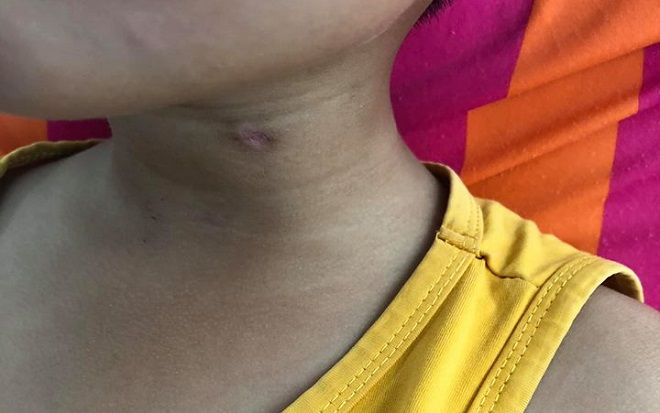 Anh nghịch súng săn của bố bắn xuyên cổ em trai nguy kịch