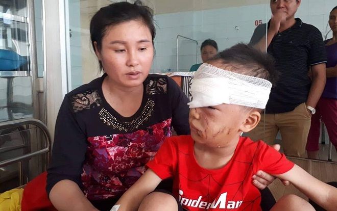 Đang chơi ngoài ngõ, bé trai 6 tuổi bị chó nhà cắn liên tiếp vào đầu và mặt