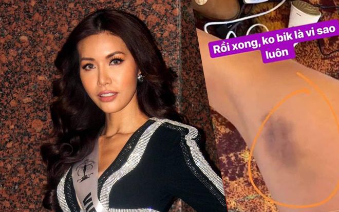 Nguy cấp: Bị bầm đen chân, Minh Tú biết 'sống sao' khi đang thi Miss Supranational 2018