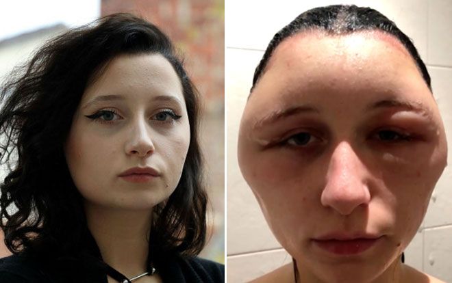 Cô gái 'tưởng như sắp chết', đầu bị biến dạng nặng nề vì thuốc nhuộm tóc mua qua mạng