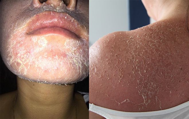 Rước họa vào thân khi sử dụng những sản phẩm lột trắng da cấp tốc