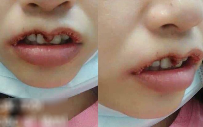 Cái kết đau đớn cho cô gái trẻ đi cắt môi trái tim: Sẹo co kéo, không khép được môi