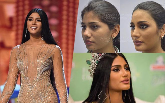Á hậu Hoàn vũ người Venezuela công khai phẫu thuật thẩm mỹ như lột xác: Chỉ điều này còn 'nguyên sơ'!