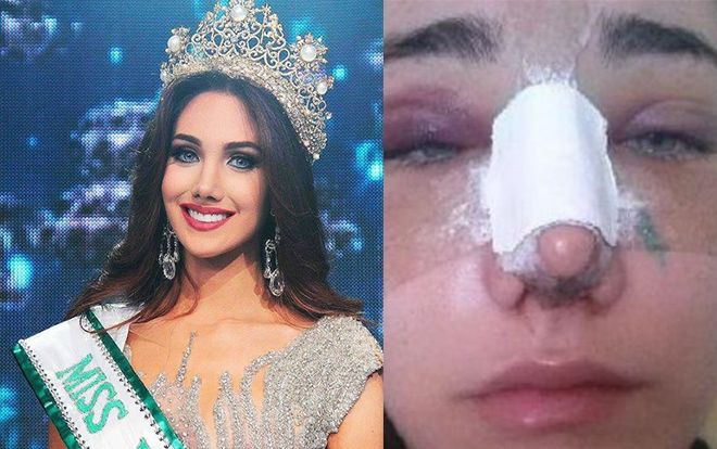 Những hoa hậu Venezuela nổi tiếng nhất thế giới với màn 'đập mặt xây lại' không tưởng