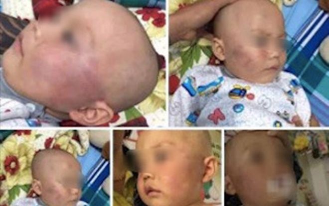 Bảo mẫu gây bức xúc khi tát sưng vù mặt bé trai 19 tháng tuổi nhưng lại nói dối bé té cầu thang